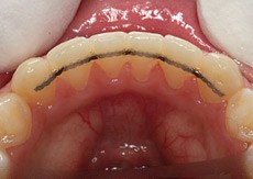 Permanent Retainers