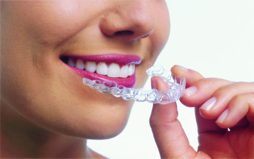 Removable Retainers